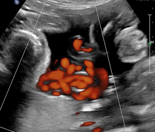 Figure 6 Power Doppler imaging of complex umbilical cord entanglement in monochorionic monoamniotic twins at 27 weeks’ gestation.