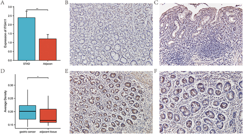Figure 8 RT-qPCR and IHC of ITGA11 overexpression in STAD tissue compared to the adjacent noncancerous tissue. (A) RT-qPCR comparison of ITGA11 expression levels in STAD tissues versus adjacent noncancerous tissues. (B and C) Immunohistochemical images of ITGA11 expression in adjacent noncancerous tissue (×200). (D) IHC comparison of ITGA11 expression between STAD tissue and adjacent noncancerous tissue. (E and F) Immunohistochemical images of ITGA11 in STAD tissues (×200). *p < 0.05; **p < 0.01.