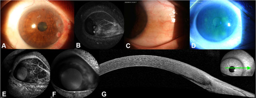 Figure 1 Three-year follow-up of case 1, a 60-year-old male patient who had primary ocular surface squamous neoplasia in the right eye (A), with a focal pattern of intratumoral vessels ((B) indocyanine green angiography [ICGA]) at baseline. Anterior segment photography reveals that there is no tumor recurrence, only a small spot in the palpebral fissure at 3 o’clock (C), as well as rough corneal epithelium in the upper nasal quadrant, and scattered fluorescein staining dots (D). Early-phase ICGA visualizes a patch of non-perfusion in the palpebral fissure, with no intratumoral or conjunctival feeding vessels (E). Late-phase fluorescein angiography demonstrates corneal leakage (F), which is in accordance with the rough corneal epithelium and scattered fluorescein staining dots in (D) due to corneal injury by the patient. Anterior segment optical coherence tomography (AS-OCT; G) reveals a bright white tear-film layer overlying the cornea and conjunctiva, with a continuous thin corneal epithelium, without any high reflectance or abnormal thickening (green arrow indicates the direction of AS-OCT scanning).