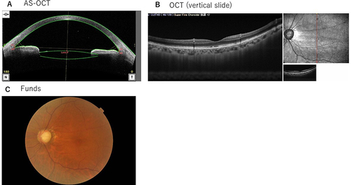 Figure 2 Patient 1’s AS-OCT, OCT, and Fundus results at 36 days after SF6 gas tamponade treatment. (A) The AS-OCT demonstrated that the ciliary body was attached. (B) As shown by OCT, retinal folds were improved. (C) The Fundus results revealed that the retinal folds were improved.