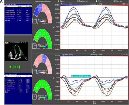 Figure 2 Left ventricular longitudinal strain analysis, visualized by two-dimensional speckle tracking echocardiography.Notes: Deformation imaging of the left ventricle was performed in both COPD patients (A) and controls (B), which showed significant differences in global and apical longitudinal deformation properties.Abbreviations: Long, longitudinal; Max, maximum; Seg, segments; PK, peak; TPk, time to peak; GLS, global longitudinal strain; endo, endocardial.