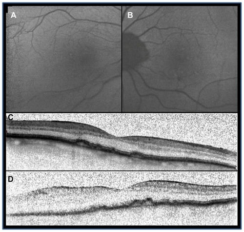 Figure 3 Fundus autofluorescence images (A and B) and optical coherent tomography images (C and D).