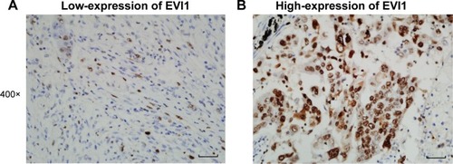 Figure 1 Representative images of high-expression and low-expression EVI1 detected with IHC.