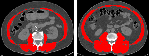 Figure 1 The red shaded part in the CT image represents the area of skeletal muscle. L3 SMI= 28.89 cm²/m². L3 SMI= 66.48 cm²/m².