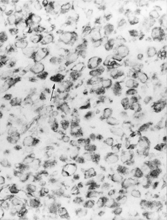 Fig. 2 Positive cytoplasmic immunostaining for vimentin. The poor tissue preservation probably accounts for the rather small number of positively staining vimentin-filament aggregates (arrow), × 250.