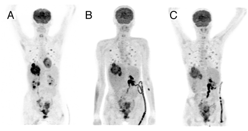 Figure 1. Functional imaging at different treatment time points. [F-18]2-deoxy-2-fluoro-d-glucose positron emission tomography (F-18-FDG PET/CT) maximum intensity projection images (antero-posterior view) demonstrating the FDG uptake during the treatment course of the patient. Upon inclusion (A) high accumulation of FDG was shown within the target lesion in the liver. Quantitative evaluation of FDG uptake of the first follow-up scan after three weeks of lenalidomide monotherapy (B) revealed a reduction of the maximum standard uptake value (SUVmax) within the target lesion by 45%, from initially 12.1 to 6.7. Restaging after three weeks of combined lenalidomide and cetuximab treatment showed a slight increase of the SUVmax to 7.6.