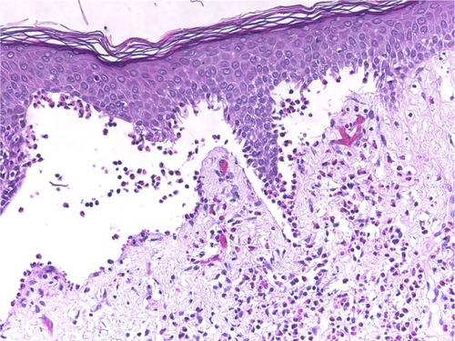Figure 7 Pemphigoid gestationis.