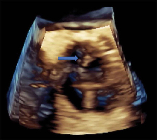 Figure 2. 3-D Echocardiogram identifying vegetation (blue arrow) on the non-coronary cusp of aortic valve.