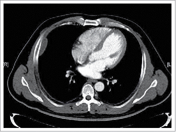 Figure 1. Tumor on the chest wall before surgery.