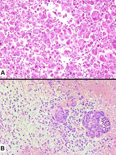 Figure 9 Histology of giant cell carcinoma showing a discohesive proliferation of bizarre, large tumor cells and the presence of sparse inflammatory infiltrates focally involving the cytoplasm of tumor cells (emperipolesis) (A). Carcinosarcoma consisting of a poorly differentiated squamous cell carcinoma (right) with a heterologous chondrosarcomatous component (left) (B).