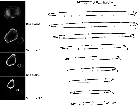 Figure 1. CT pictures and bone contours of the tibia.