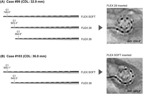 Figure 4. Image modified from the OTOPLAN results and postoperative radiographs. Each degree means the position of the tip channel (C1) of the electrode according to each selected electrode array. (A) In case #99, FLEX 28 was selected. (B) In case #103, FLEX SOFT was selected. CDL: cochlear duct length; AID: angular insertion depth.