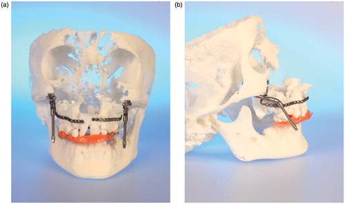 Figure 3. (a and b) CBCT-based models of a distraction case, showing the internal maxillary distraction device selected according to the model geometry, the additional acrylic splint to avoid occlusal interference, and the original devices mounted after removal of material. (c–e) Corresponding clinical pictures of the patient, who presented with a severe maxillary deficiency due to bilateral cleft: (c) The preoperative situation. (d) A cephalogram acquired during the active distraction phase. (e) The clinical situation after six months of consolidation.