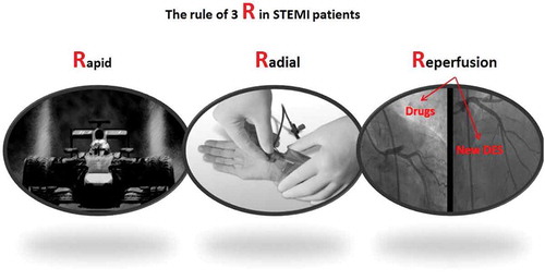 Figure 1. The rule of 3 R to treat patients presenting with ST elevation myocardial infarction.