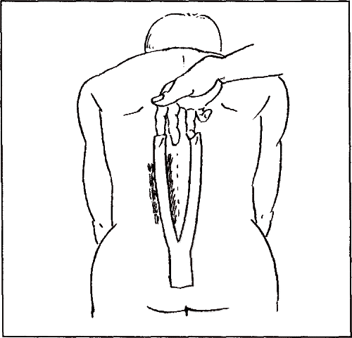 Figure 4. Y-shaped kinesio taping for lower trunk.