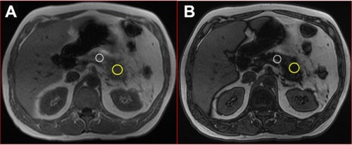 Figure 2 T1-weighted in-phase (A) and out-of-phase (B) axial images in 52-year old male who subsequently developed post-ERCP pancreatitis.