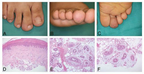 Figure 1 Clinical appearance of the skin lesion. (A–C) Swelling of the plantar surface was apparent on the right second toe. The overlying surface was erythematous with a small amount of fine scales. Histologically, the epidermis showed acanthosis with hypertrophy of the granular layer and mild elongation of rete ridges. (D) A mild, perivascular inflammatory infiltration in the upper dermis was seen (hematoxylin and eosin, original magnification x40). (E) A nodular proliferation of normally structured eccrine coils and ducts in the deep dermis and subcutaneous fat tissue. Some of the ducts show mild dilation. Extravasation of erythrocytes was also noted around the proliferation of eccrine glands (hematoxylin and eosin, original magnification x200). (F) Proliferation of small capillary-sized vessels in the stroma surrounding the eccrine glands in the subcutaneous fat tissues (hematoxylin and eosin, original magnification x200).
