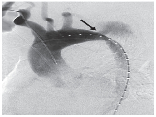 Figure 2 Arch angiogram showing the proximal entry tear into the false lumen (arrow).