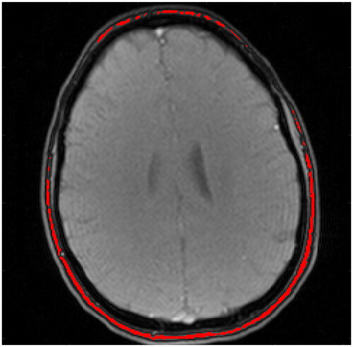 Figure 3. Example fat mask (of bone marrow) with volunteer 1, slice 1. The fat mask is overlaid on the magnitude image of echo 1 at time point 2.