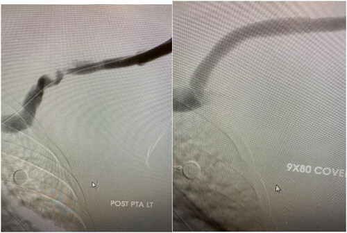 Figure 4. Left: Cephalic arch stenosis. Right: Stent placement for management of cephalic arch stenosis.