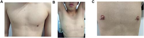 Figure 2 Preoperative and postoperative chest signs of Case 1. (A) Preoperative chest signs of Case 1 (the lower left is artificial skin injury, not nipple). (B) Sign of axillary hair absence in Case 1. (C) Chest sign of Case 1 one year after nipple reconstruction and embroidery.