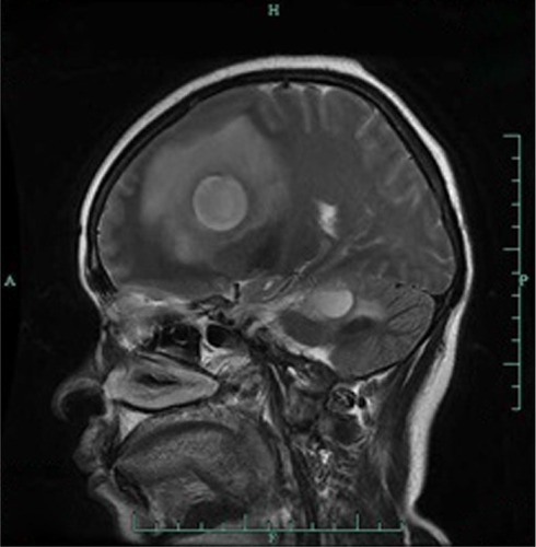 Figure 3 T2WI of head MRI showing mass in the right frontal lobe.