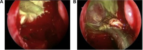 Figure 3 Images during FESS.