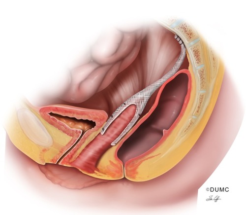 Figure 3 Mesh sacrocolpopexy. Whether performed abdominally or via minimally invasive techniques, mesh is attached to the anterior and/or posterior walls of the vagina. The “tail” of the mesh is attached to the anterior longitudinal ligament of the sacrum.