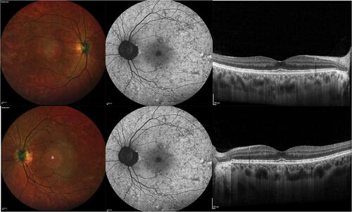 Figure 3 Multimodal imaging from a female CHM carrier. Multicolor images (left) show areas of RPE alteration and mottling in the macula. Blue fundus autofluorescence images (middle) show a characteristic pattern of speckled autofluorescence. Structural OCT images (right) demonstrate a normal appearance of the macular retina and choroid.