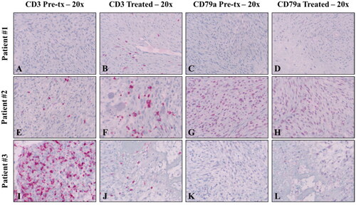 Figure 6. Immunohistochemistry to investigate tumor-infiltrating lymphocytes (TILs) was performed on pretreatment (tx) samples as well as untreated and treated tumor samples using antibodies against CD3 (T-cells) and CD79a (B-cells). No significant changes in TIL populations were observed between pretreatment, untreated, and histotripsy-treated samples for either antibody. All IHC samples utilized a red chromogen and hematoxylin counterstain. Magnifications are noted in the figure headings.