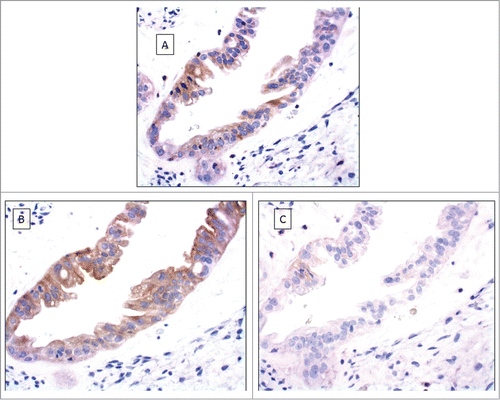 Figure 3. Cumulative survival by Kaplan–Meier analysis. All cases are HLA-G positive tumors with concordant loss of classical MHC. The worst prognosis was only significantly determined by HLA-A*02 genotype. HLA-A*02 (X), HLA-A otherwise (•). p = 0.003.