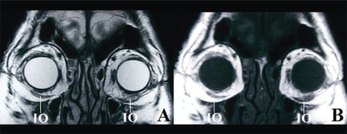 Figure 2 Figure 2A The left IO is inflamed and enlarged on coronal T2-weighted MRI. By comparing with Figure 2B, the inflammation can be clearly seen.Figure 2B The swollen left IO includes some adipose tissue on coronal T1-weighted MRI.