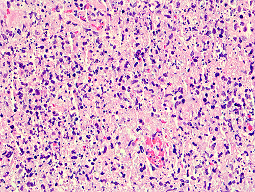 Figure 4 Pathological image of lymph node (40X).