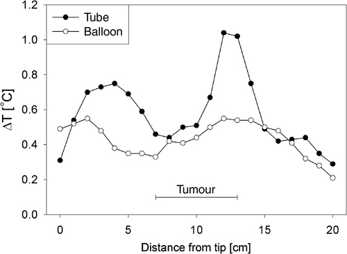 Figure 2. Typical ΔT profiles along the thermocouple tracks measured simultaneously in a nasogastric tube and with a balloon catheter, in an individual patient with a tumour length of 6 cm.