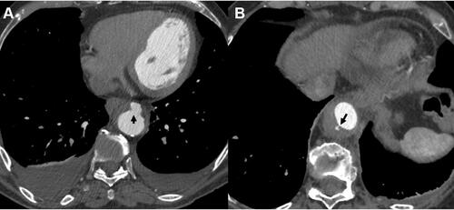 Figure 3 (A) Ulcer-like projection in the descending aorta of a patient with aortic intramural hematoma (arrow). (B) Tiny intimal disruption corresponding to an artery branch ostium (arrow).