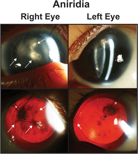 Figure 2. Aniridia. Slit lamp photos (top row) and backlit photos (bottom row) of a patient with aniridia shows keratopathy (white arrows) which is worse in the right eye the the left eye. In the right eye, the white arrows point to the same areas of keratopathy in both the slit lamp and backlit photographs. In the left eye, the white arrows points to a peripheral pannus that is more obvious in the backlit photograph. Both eyes have a superotemporal glaucoma drainage device (asterisk) which due to the proxmity to the lens has caused a focal cataract (black arrow).