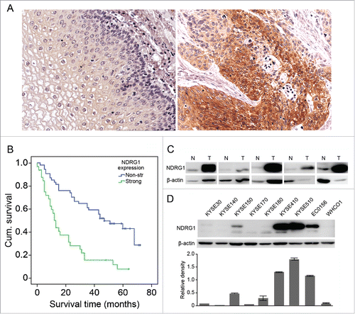 Figure 1. NDRG1 overexpression was correlated with poor overall survival in esophageal cancer. (A) Expression of NDRG1 was analyzed by immunohistochemical analysis in TMAs containing 78 ESCC tumor and adjacent normal epithelial tissues, with duplicate cores used for each case. The majority of tumor areas strongly express NDRG1 in the cytoplasm. Magnification, 200×. (B) Kaplan-Meier curve combined with Log-rank analysis for patients with ESCC showing weak and strong NDRG1 expression. (C) NDRG1 expression in a subset of ESCC (T) and matched non-neoplastic surgical tissues (N) was analyzed by Western blot analysis. (D) Whole cell protein extracts from 9 esophageal cancer cell lines were subjected to protein gel blot analysis using antibodies against NDRG1. Quantitative values of relative NDRG1 levels were normalized to β-actin (mean ± SD).