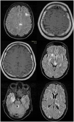 Figure 1 Brain MRI of the patient suspected for CsA-induced neurotoxicity, a bilateral hyperintense patch of white matter in the supratentorial and infratentorial territories with gray matter changes.