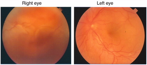Figure 1. Fundus photographs of both eyes on admission, showing vitreous opacity and serous retinal detachment in right eye, and hyperemic optic disk and serous retinal detachment in left eye.
