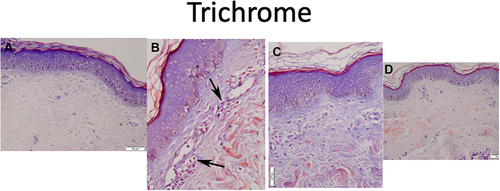 Figure 2 Skin biopsy from striae stained with Trichrome stain (scale 50 μm). (A) Before treatment, (B) after 3 sessions of combined treatment, (C) after 3 sessions of fractional laser/RF, (D) after 3 sessions of PRP. Note the increase in collagen fibres. Black arrows show increase in fibroblasts with treatment.