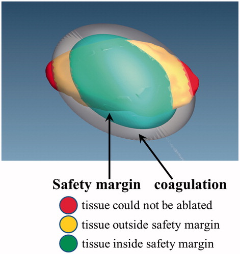 Figure 6. The 3D tumour model and colour scheme of the coagulation zones. Red, tumour tissue not ablated; yellow, tissue outside of margin; green, tissue inside margin.
