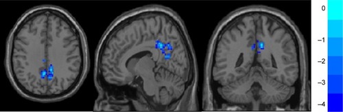 Figure 2 Lower fALFF value in the MDD group: bilateral precuneus and middle cingulate cortex.