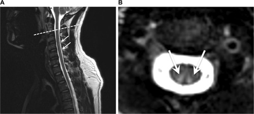 Figure 1 Sagittal (A) and axial (B) T2W-weighted MRI of the cervical spine revealing marked hyperintense posterior columns.