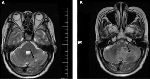 Figure 3 Brain MRI.