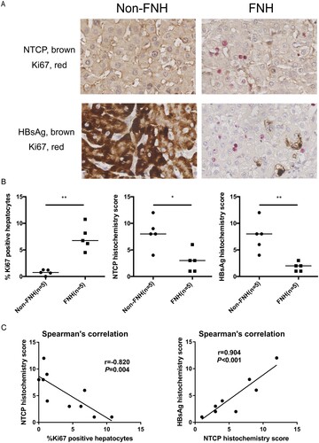 Figure 3. FNH tissues contain more Ki67-positive hepatocytes, along with significantly lower NTCP and HBsAg expression. (A) Immunohistochemical double staining of Ki67, NTCP and HBsAg in FNH tissues and adjacent non-FNH tissues. The top row showed the double staining of NTCP (brown) and Ki67 (red), and the bottom row showed the double staining of HBsAg (brown) and Ki67 (red). (B) The percentage of Ki67-positive hepatocytes (calculated by the average of five counted fields in every tissue) and the histochemistry scores of NTCP and HBsAg (calculated by positive hepatocyte ratio multiplied with the staining intensity). (C) Spearman's correlation of NTCP histochemistry scores and the percentage of Ki67-positive hepatocytes, the histochemistry scores of NTCP and HBsAg (*P < 0.05; **P < 0.01; ***P < 0.001).