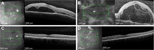 Figure 3 Spectral-domain optical coherence tomography at preimplantation and 5 months following bilateral implantation of sustained-release dexamethasone intravitreal implants in patient diagnosed with Vogt–Koyanagi–Harada syndrome.