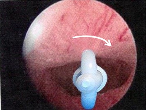 Figure 3 The figure shows an oval shaped internal cervical os.