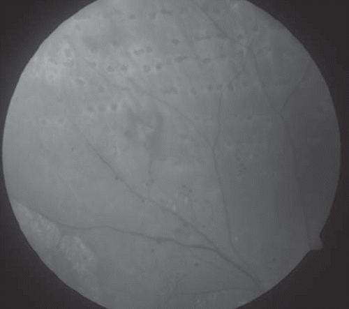 Figure 2. Fundus photograph of the right eye of a patient treated with 125I plaque for a choroidal melanoma showing microaneurysms, telangiectases, and retinal neovascularization secondary to radiation retinopathy. Note the laser photocoagulation scars.