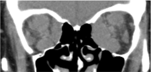 Figure 2 Multislice CT scan (coronal plane) prior to orbital decompression.