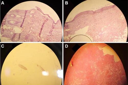 Figure 5 Low power microscopic view (A) showing tissue lined by stratified squamous epithelium with associated hair follicles and sebaceous glands. High power microscopic view (B) showing in the surface lined by stratified squamous epithelium with associated hair follicles and sebaceous glands. Microscopic (C); hair shaft material. Extensive hemorrhage, congestion, dilated blood vessels, and ischemia of mucosa and parenchyma (D).